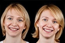 установка зубных имлпантов